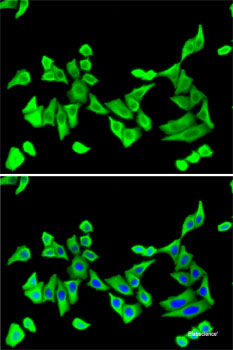 Immunohistochemistry of paraffin-embedded Human liver cancer using LY86 Polyclonal Antibody at dilution of 1:200 (40x lens).