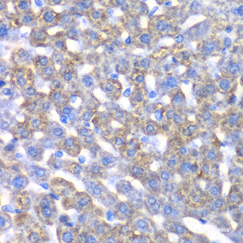 Immunohistochemistry of paraffin-embedded Human well-differentiated squamous skin carcinoma using PUF60 Polyclonal Antibody at dilution of 1:100 (40x lens).