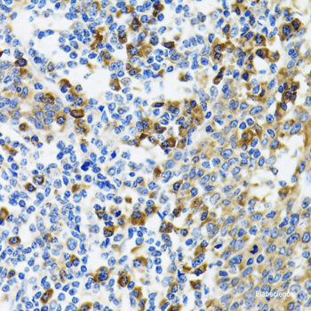 Immunohistochemistry of paraffin-embedded Human liver damage using TRAF3IP2 Polyclonal Antibody at dilution of 1:100 (40x lens).