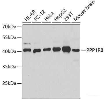 Immunohistochemistry of paraffin-embedded Human liver cancer using DHODH Polyclonal Antibody at dilution of 1:100 (40x lens).