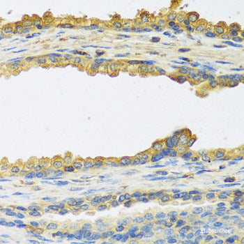 Immunohistochemistry of paraffin-embedded Human colon carcinoma using SSBP1 Polyclonal Antibody at dilution of 1:100 (40x lens).