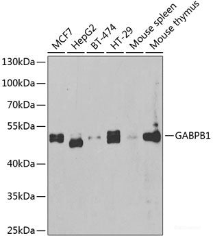 Immunohistochemistry of paraffin-embedded Human well-differentiated squamous skin carcinoma using DNAJB6 Polyclonal Antibody at dilution of 1:100 (40x lens).