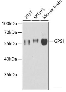 Immunohistochemistry of paraffin-embedded Human liver cancer using VTI1B Polyclonal Antibody at dilution of 1:100 (40x lens).