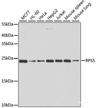 Immunohistochemistry of paraffin-embedded Human lung cancer using TRMT1 Polyclonal Antibody at dilution of 1:100 (40x lens).