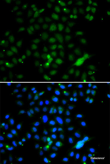 Immunohistochemistry of paraffin-embedded Human brain cancer using ZNF20 Polyclonal Antibody at dilution of 1:100 (40x lens).