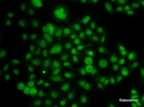 Immunohistochemistry of paraffin-embedded Human liver cancer using SHBG Polyclonal Antibody at dilution of 1:100 (40x lens).