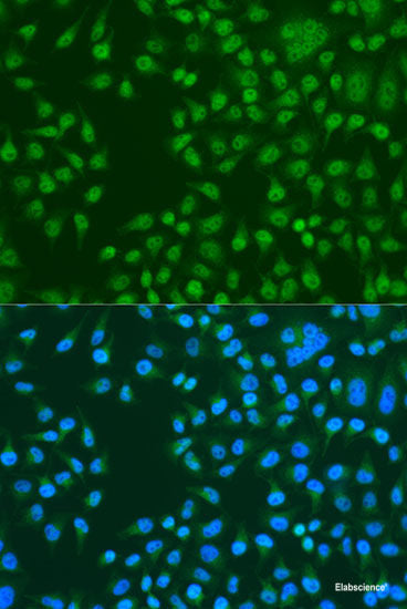 Immunohistochemistry of paraffin-embedded Human lung cancer using ARFIP2 Polyclonal Antibody at dilution of 1:100 (40x lens).