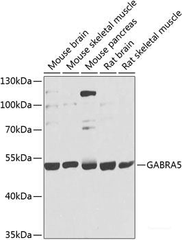 Immunohistochemistry of paraffin-embedded Human breast carcinoma using Phospho-GSK3B(Y216)/GSK3A(Y279)Polyclonal Antibody