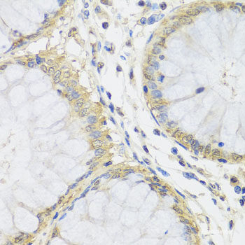 Immunohistochemistry of paraffin-embedded Human liver damage using CETN3 Polyclonal Antibody at dilution of 1:100 (40x lens).