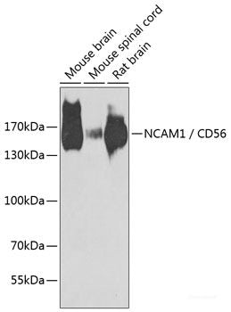 Immunohistochemistry of paraffin-embedded Human liver cancer using CEACAM7 Polyclonal Antibody at dilution of 1:100 (40x lens).