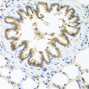 Immunohistochemistry of paraffin-embedded Human liver cancer using CD31 Polyclonal Antibody at dilution of 1:100 (40x lens).