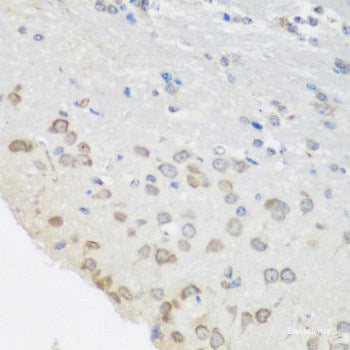 Immunohistochemistry of paraffin-embedded Human liver cancer using ASL Polyclonal Antibody at dilution of 1:100 (40x lens).