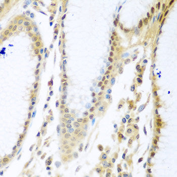 Immunohistochemistry of paraffin-embedded Human kidney cancer using CBFB Polyclonal Antibody at dilution of 1:200 (40x lens).