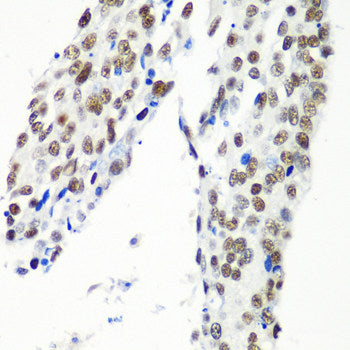 Immunohistochemistry of paraffin-embedded Human liver damage using M6PR Polyclonal Antibody at dilution of 1:100 (40x lens).