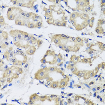 Immunohistochemistry of paraffin-embedded Human oophoroma using TERF2IP Polyclonal Antibody at dilution of 1:100 (40x lens).