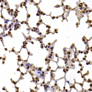 Immunohistochemistry of paraffin-embedded Human liver cancer using TFPI2 Polyclonal Antibody at dilution of 1:200 (40x lens).