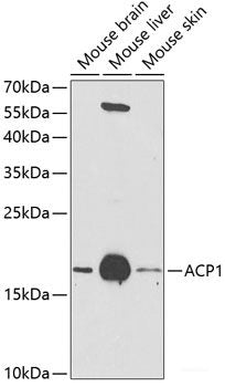 Immunohistochemistry of paraffin-embedded Human esophageal cancer using EXO1 Polyclonal Antibody at dilution of 1:100 (40x lens).