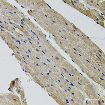 Immunohistochemistry of paraffin-embedded Human breast cancer using MTCH1 Polyclonal Antibody at dilution of 1:100 (40x lens).