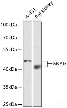 Immunohistochemistry of paraffin-embedded Human liver cancer using IKK beta Polyclonal Antibody at dilution of 1:100 (40x lens).