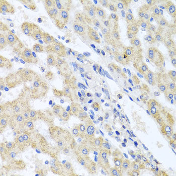 Immunohistochemistry of paraffin-embedded Human colon carcinoma using UBE2S Polyclonal Antibody at dilution of 1:100 (40x lens).