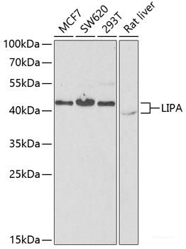 Immunohistochemistry of paraffin-embedded Human liver cancer using CAPNS1 Polyclonal Antibody at dilution of 1:100 (40x lens).