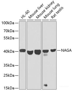 Immunohistochemistry of paraffin-embedded Human breast carcinoma tissue, using Phospho-Bcl-2(T56) Polyclonal Antibody