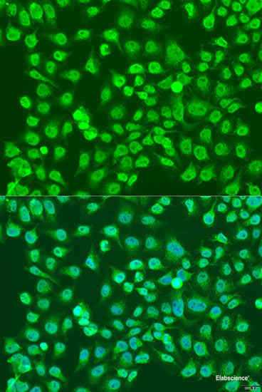Immunohistochemistry of paraffin-embedded Human lung cancer using MDC1 Polyclonal Antibody at dilution of 1:100 (40x lens).