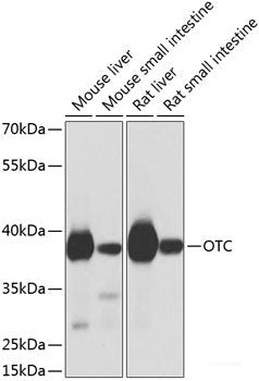 Immunohistochemistry of paraffin-embedded Human gastric cancer using Phospho-γH2A.X(S139) Polyclonal Antibody at dilution of 1:200 (40x lens).