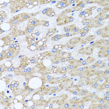 Immunohistochemistry of paraffin-embedded Human liver damage using PSMD8 Polyclonal Antibody at dilution of 1:100 (40x lens).
