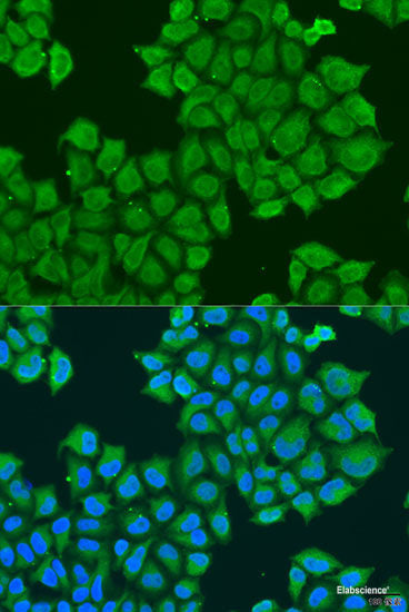 Immunohistochemistry of paraffin-embedded Human uterine cancer using GABPA Polyclonal Antibody at dilution of 1:100 (40x lens).