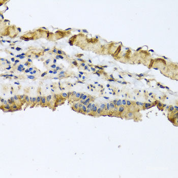 Immunohistochemistry of paraffin-embedded Human liver damage using RHOB Polyclonal Antibody at dilution of 1:100 (40x lens).