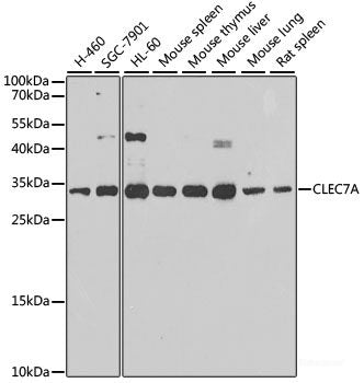 Immunohistochemistry of paraffin-embedded Human lung carcinoma tissue, using Phospho-PKCalpha/beta II(T638/641) Polyclonal Antibody