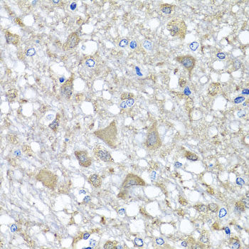 Immunohistochemistry of paraffin-embedded Human liver damage using OSGEPL1 Polyclonal Antibody at dilution of 1:100 (40x lens).