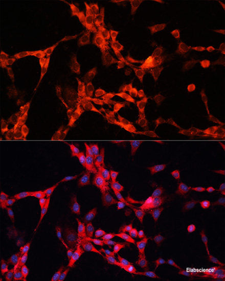 Immunohistochemistry of paraffin-embedded Human lung cancer using ART1 Polyclonal Antibody at dilution of 1:100 (40x lens).
