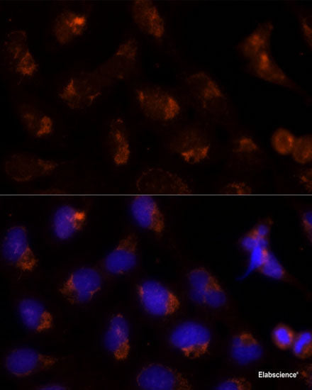Immunohistochemistry of paraffin-embedded Human prostate cancer using BMP4 Polyclonal Antibody at dilution of 1:100 (40x lens).