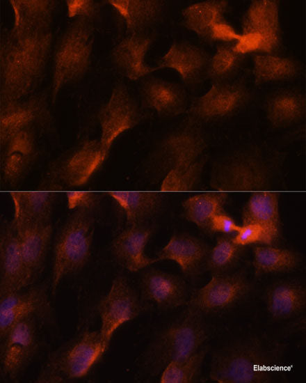 Immunohistochemistry of paraffin-embedded Human breast cancer using BRCA1 Polyclonal Antibody at dilution of 1:100 (40x lens).