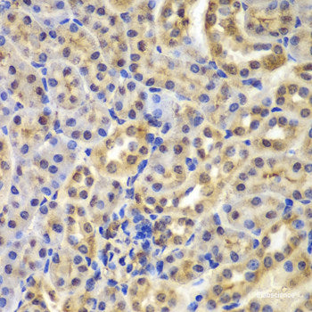 Immunohistochemistry of paraffin-embedded Human liver cancer using GAS2 Polyclonal Antibody at dilution of 1:200 (40x lens).