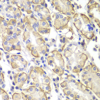 Immunohistochemistry of paraffin-embedded Human liver cancer using AFP Monoclonal Antibody at dilution of 1:12.5 (40x lens).