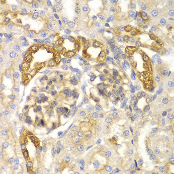Immunohistochemistry of paraffin-embedded Human lung cancer using FIGF Polyclonal Antibody at dilution of 1:200 (40x lens).
