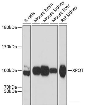 Immunohistochemistry of paraffin-embedded Human lung cancer using ADSS Polyclonal Antibody at dilution of 1:100 (40x lens).