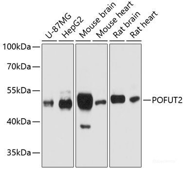 Immunohistochemistry of paraffin-embedded Human liver cancer using Cox2 Polyclonal Antibody at dilution of 1:200 (40x lens).