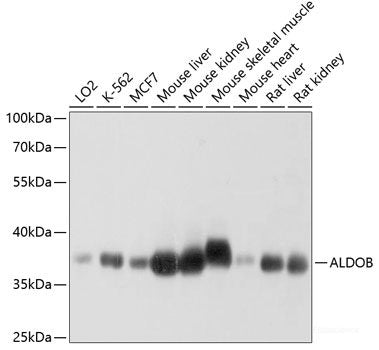 Immunohistochemistry of paraffin-embedded Human gastric cancer using DHX38 Polyclonal Antibody at dilution of 1:150 (40x lens).