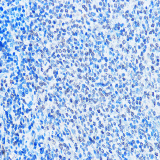 Immunohistochemistry of paraffin-embedded Human lung cancer using RFC5 Polyclonal Antibody at dilution of 1:100 (40x lens).