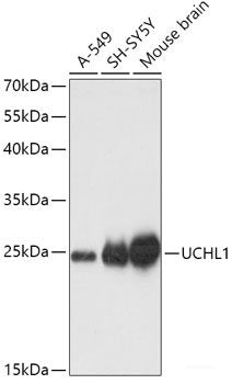 Immunohistochemistry of paraffin-embedded Human breast cancer using ATG7 Polyclonal Antibody at dilution of 1:100 (40x lens).