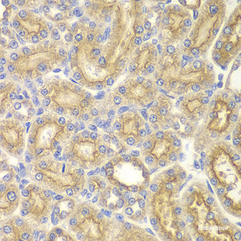 Immunohistochemistry of paraffin-embedded Human liver cancer using CytokeRatin-18 Polyclonal Antibody at dilution of 1:100 (40x lens).