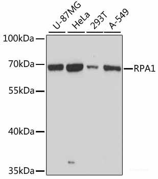 Immunohistochemistry of paraffin-embedded Human lung cancer using TIAM1 Polyclonal Antibody at dilution of 1:100 (40x lens).