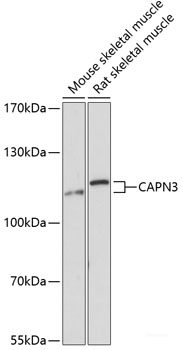 Immunohistochemistry of paraffin-embedded Human liver cancer using TNFSF13 Polyclonal Antibody at dilution of 1:100 (40x lens).