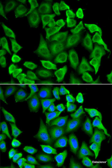 Immunohistochemistry of paraffin-embedded Human mammary cancer using VEGFB Polyclonal Antibody at dilution of 1:200 (40x lens).