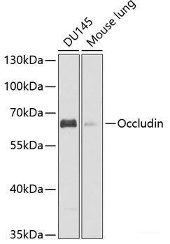 Immunohistochemistry of paraffin-embedded Human colon carcinoma using CLDN4 Polyclonal Antibody at dilution of 1:150 (40x lens).