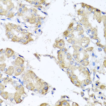 Immunohistochemistry of paraffin-embedded Human lung cancer using DKC1 Polyclonal Antibody at dilution of 1:100 (40x lens).